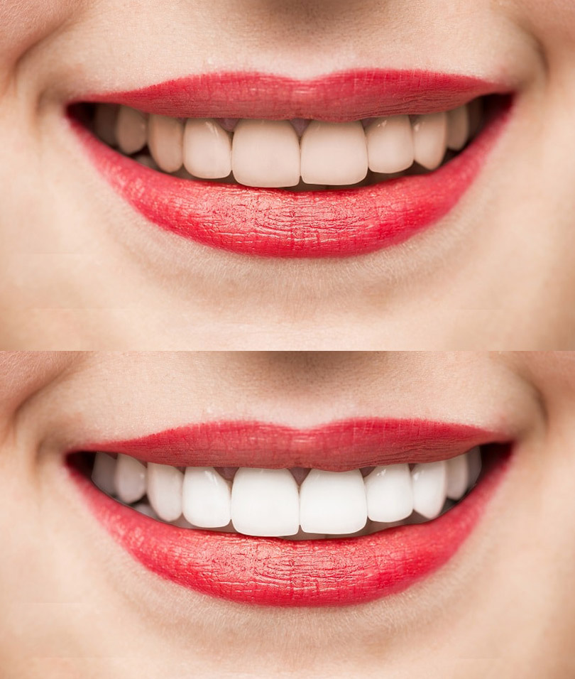 teeth whitening before and after