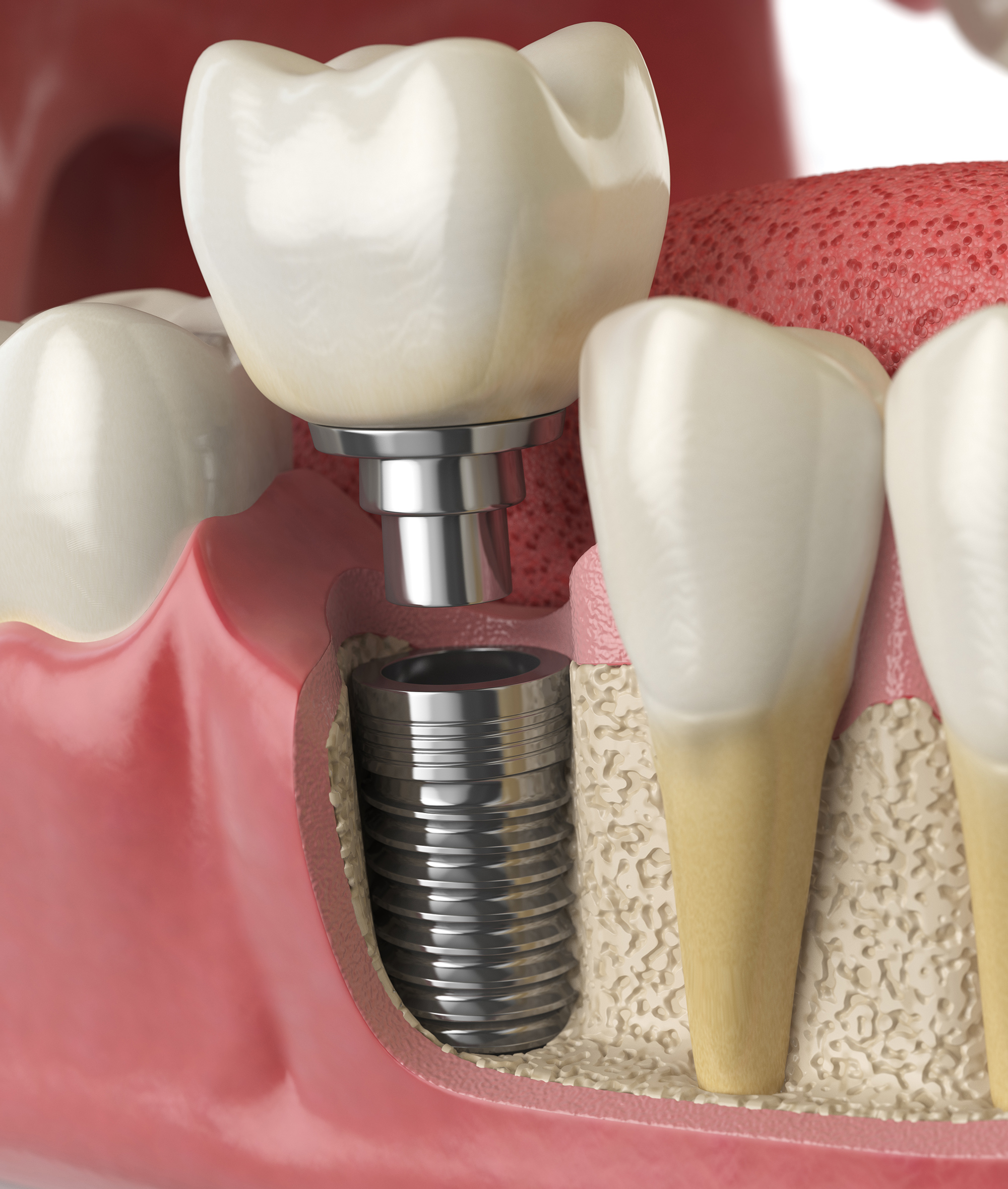 Dental implant restoration