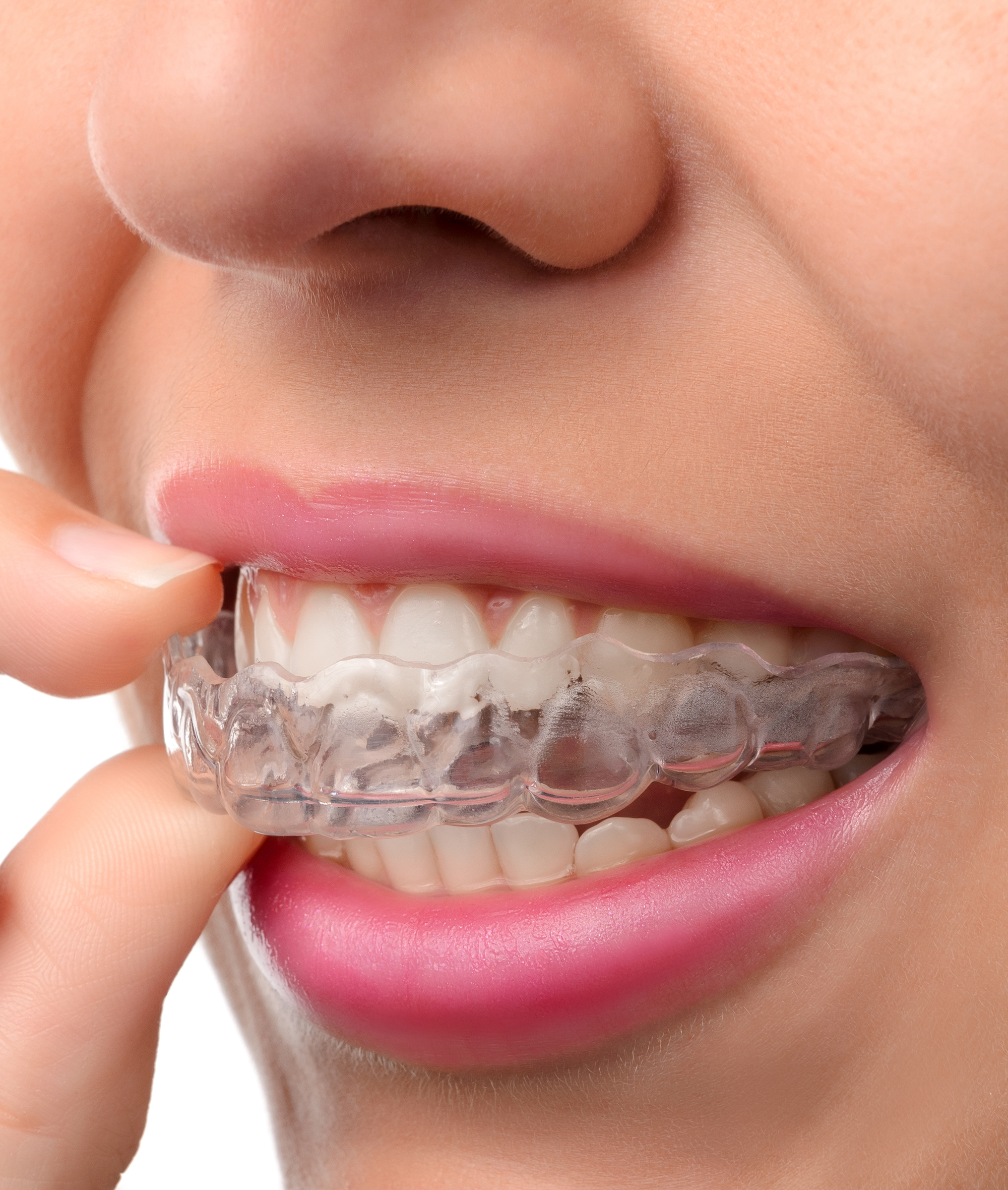 Invisalign