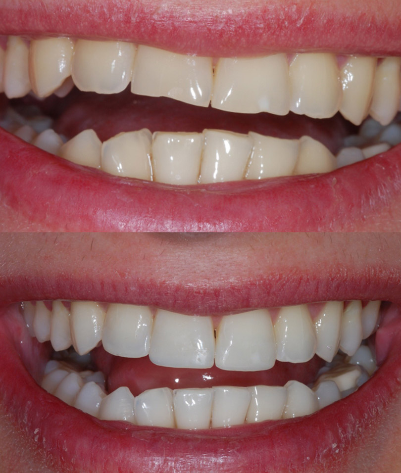 dental bonding before and after