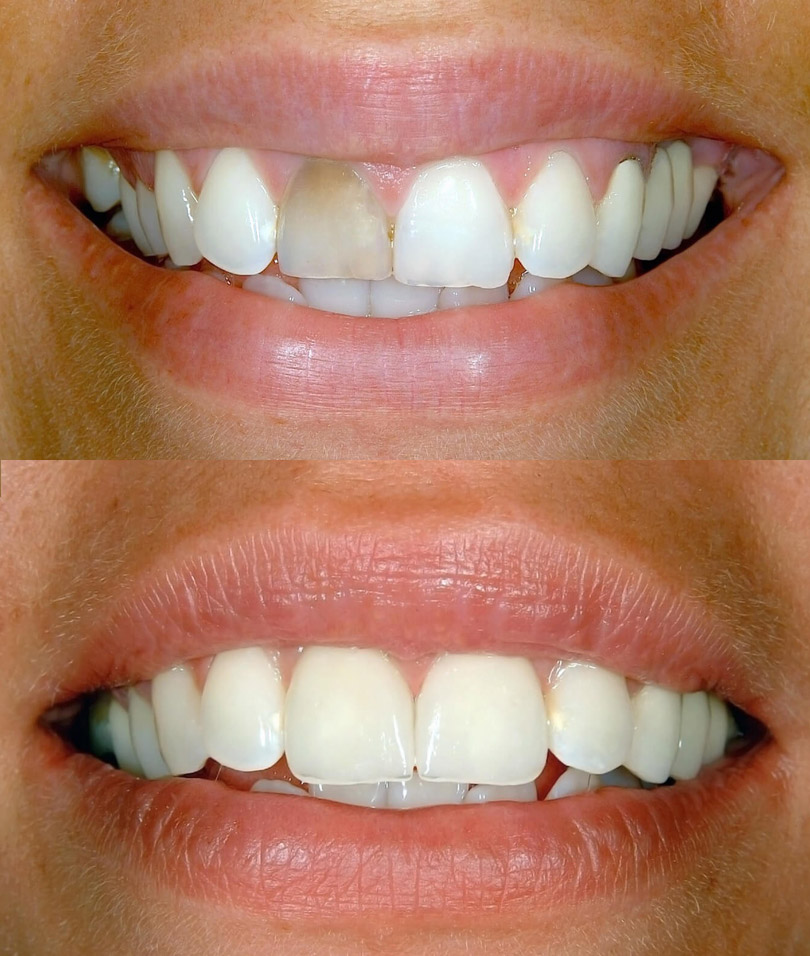 porcelain veneers