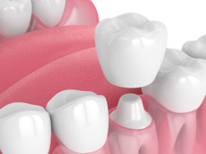 dental crowns
