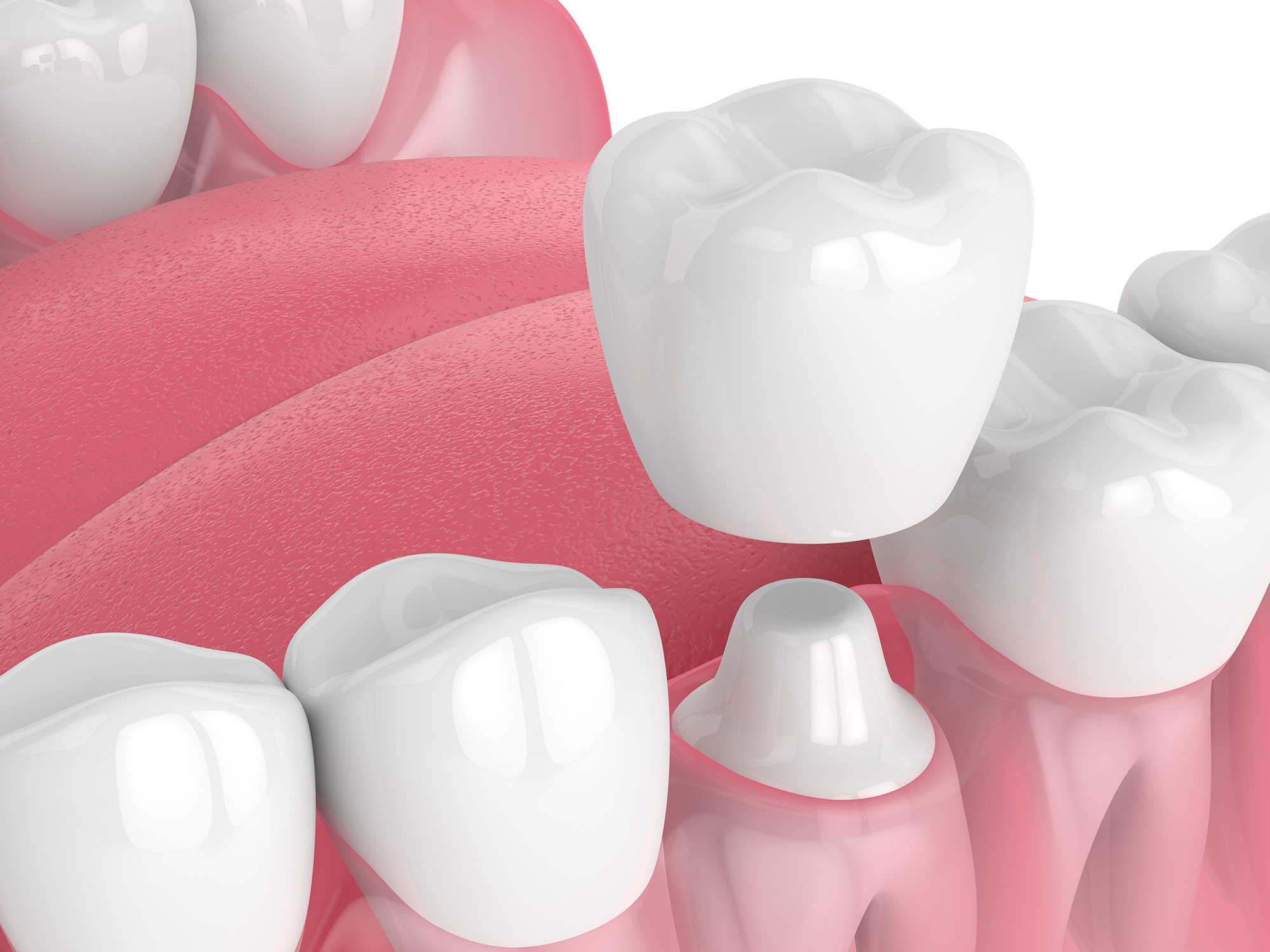 CEREC Crowns VS Traditional Dental Crowns