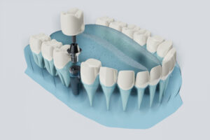 Lower Jaw Dental Implant