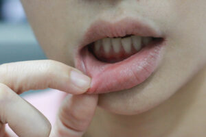 canker sore