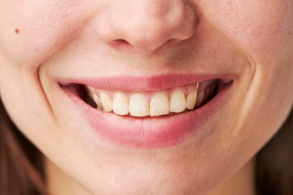 Woman With Brown Teeth