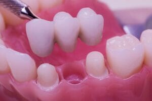 5 Common Dental Bridge Problems and How to Fix Them