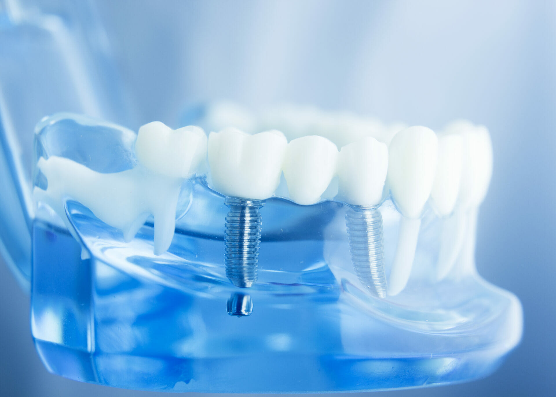 What is the downside of dental implants