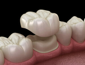 5 Things to Know about Dental Crowns