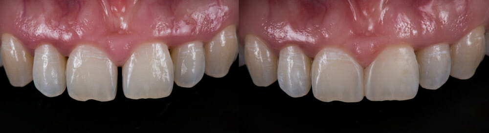 before and after of dental bonding