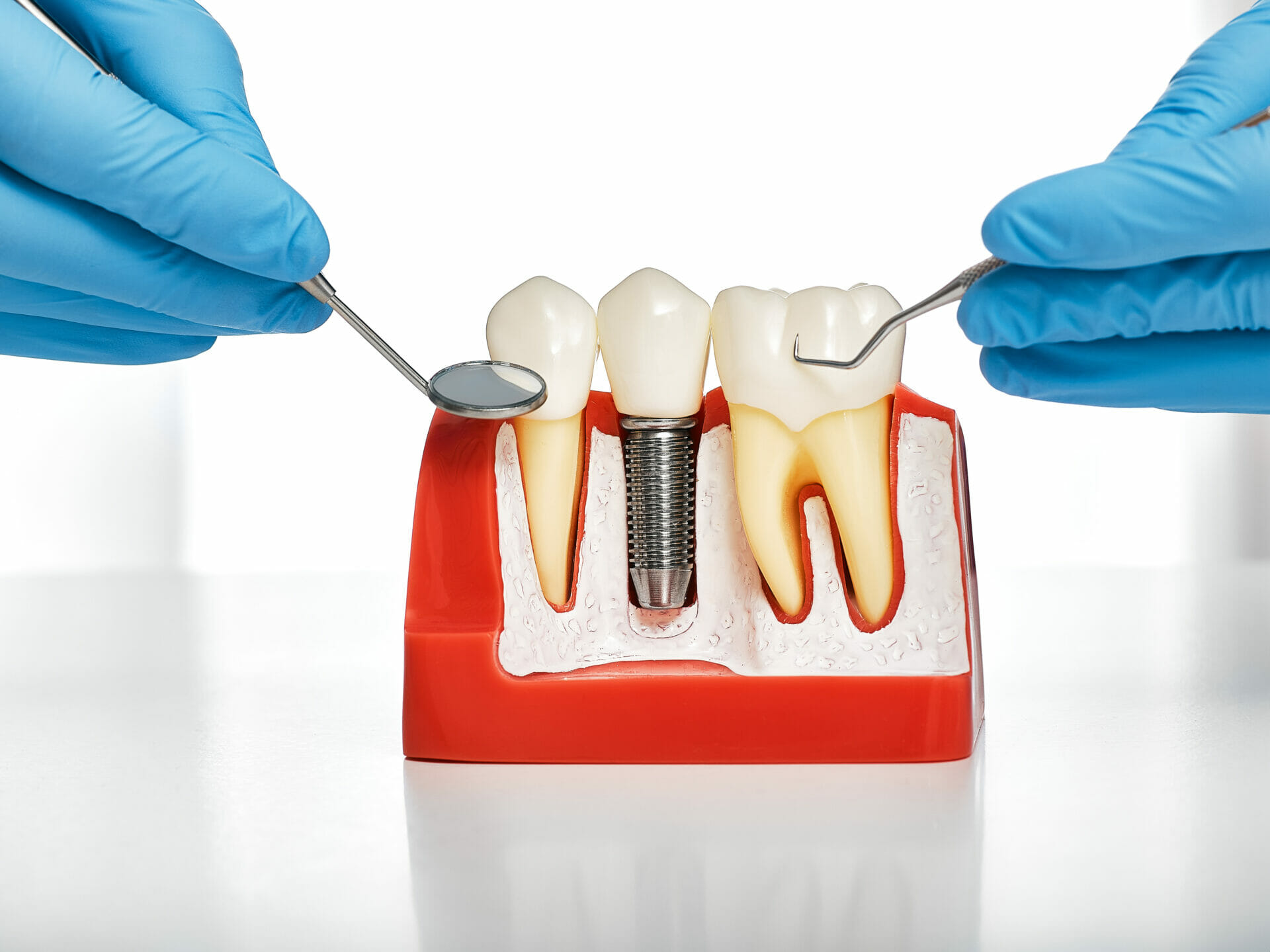 dental implant figure