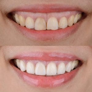 Transform Your Smile: What is a Smile Makeover