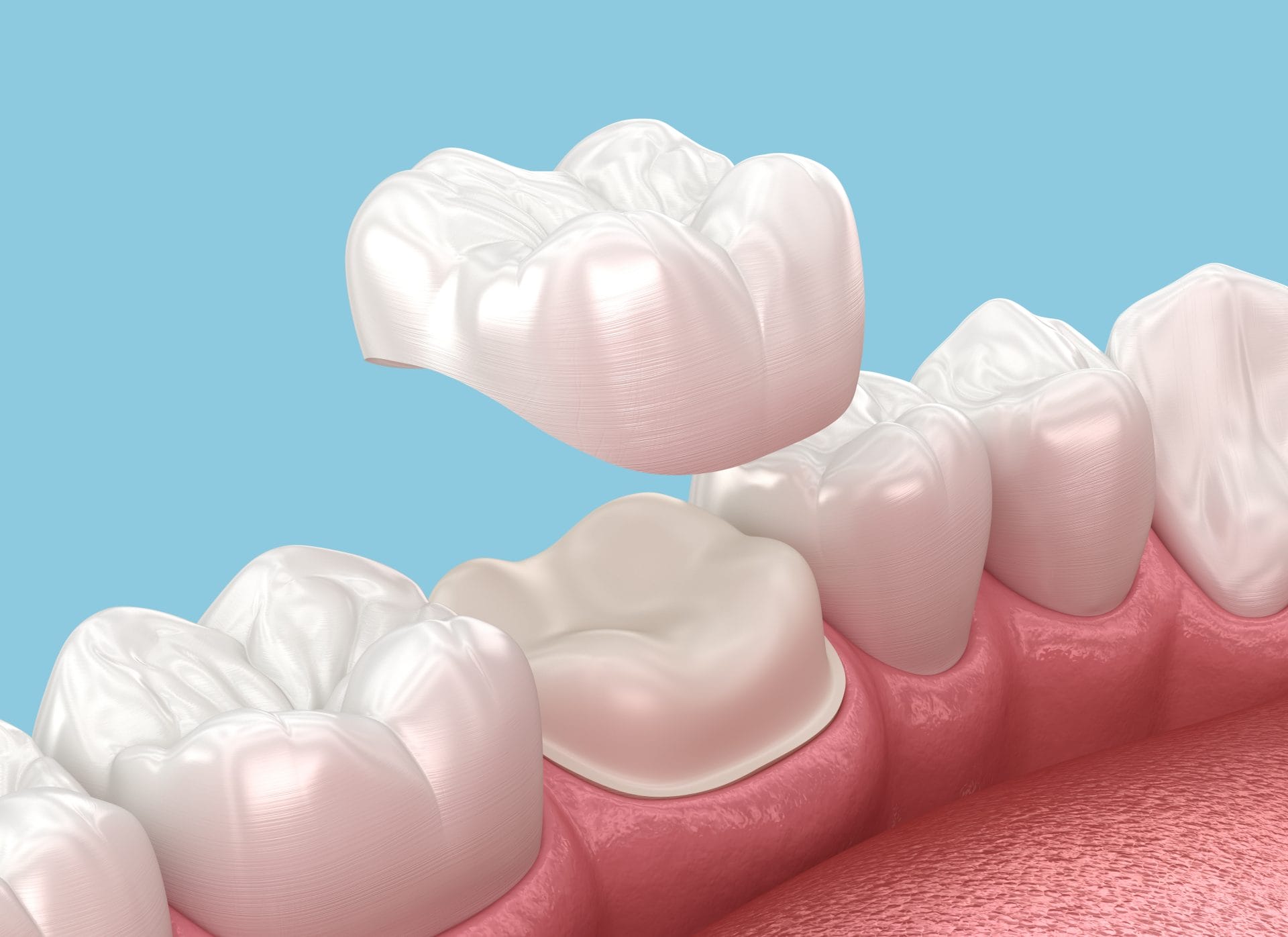 Is It Time to Replace Your Dental Crown? Signs to Watch For