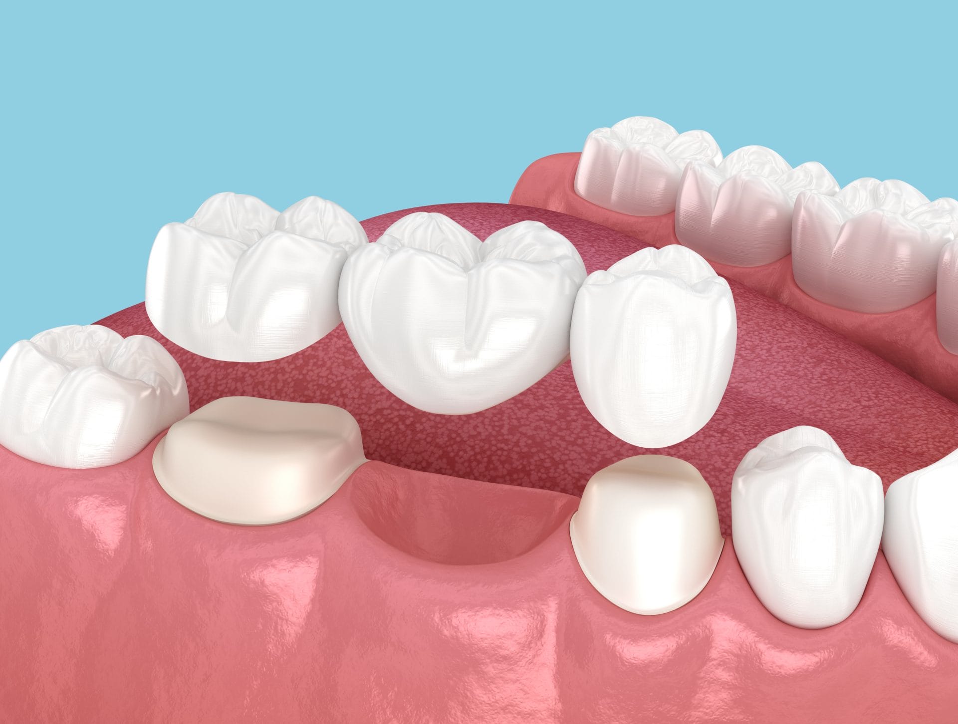 What Is a Dental Bridge and When Is It the Right Option?