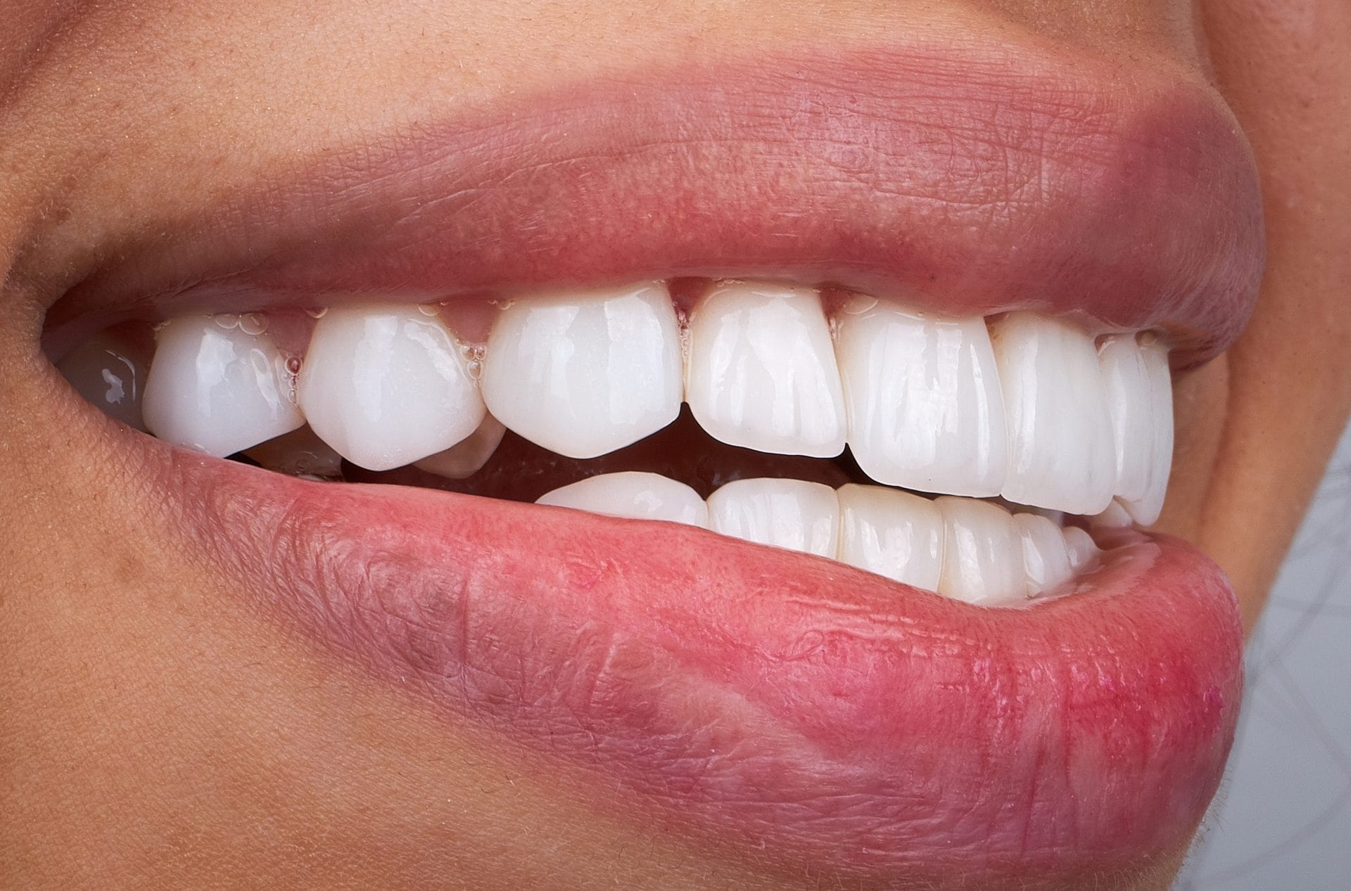 Tooth Colored Fillings for a Natural, Confident Smile